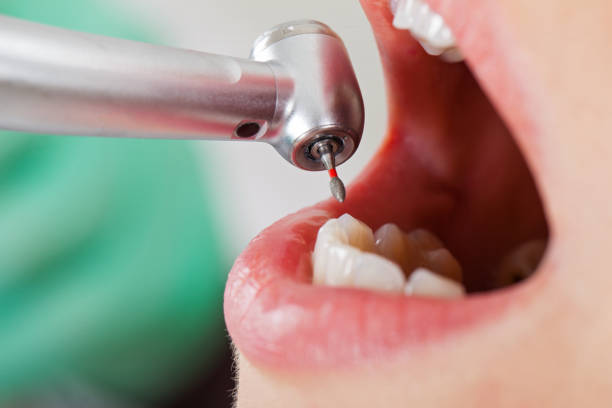 Best Emergency Dental Care for Abscessed Tooth in Boronda, CA